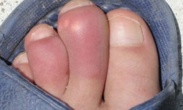 what is gout in the foot caused by